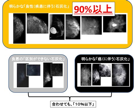 微細石灰化の集簇|「マンモグラフィで石灰化」が見つかる原因はご存知。